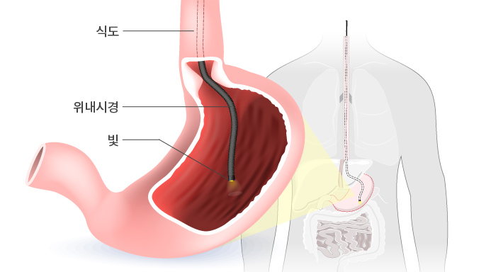 위내시경이란? 구강을 통해 내시경을 삽입하고 식도/위/십이지장의 내부를 관찰하는 검사입니다. 검사를 위해 푸른색의 색소를 뿌리기도 하고, 현미경으로 관찰할 조직 검사도 하고 있습니다.