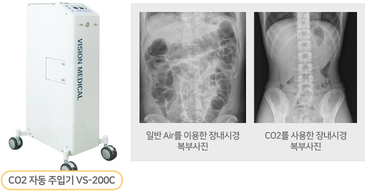 CO2 자동 주입기 VS-200C  일반 Air를 이용한 장내시경복부사진  CO2를 사용한 장내시경
복부사진  