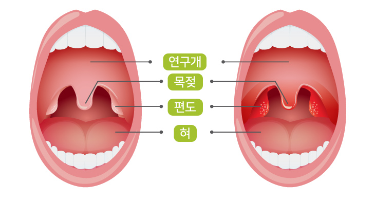 인후염 흔히 말하는 감기, 목 감기, 상기도 감염에 해당하는 질병으로 베타 용혈성 사슬알균, 포도알균, 폐렴알균, 헤모필루스균과 혐기성 균주와 같은 세균 또는 인플루엔자 바이러스, 단순포진 바이러스, 파라인플루엔자 바이러스, 콕사키 바이러스, 에코 바이러스 등과 같은 바이러스로 인하여 인두, 후두를 포함한 상기도 점막에 생기는 염증성 반응을 말합니다.